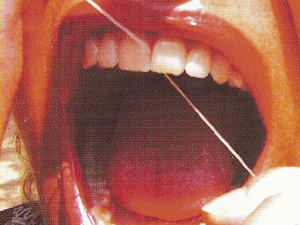 fil inter dentaire
