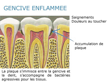 gencive enflammée