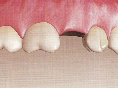 dents voisines abîmées