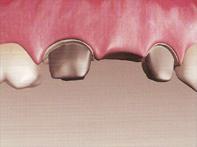 dents voisines dévitalisées