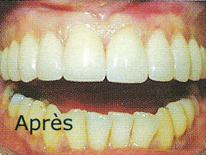 taille des dents