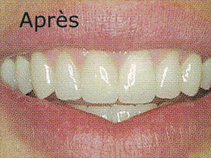 carie abîme plusieurs dents