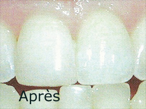 taille des dents