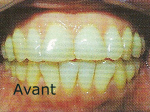 taille des dents