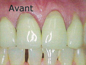 carie abîme plusieurs dents