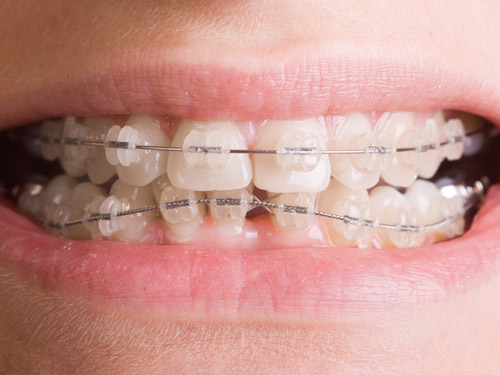 traitement orthodontique